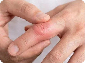 Psoriatic Arthritis - Arthritis Medical Clinic