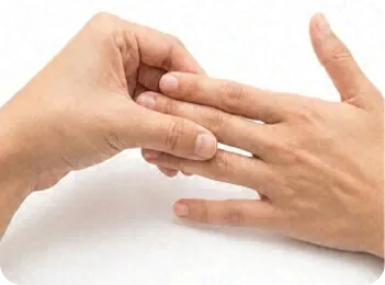 Hands of a patient with tight skin from CREST syndrome