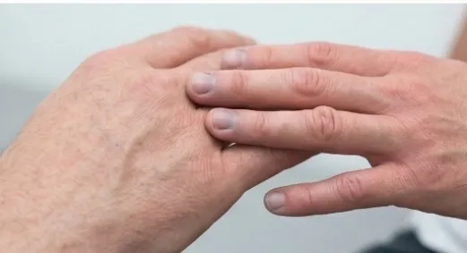 Juvenile Dermatomyositis: