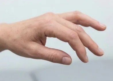 Eosinophilic Granulomatosis with Polyangiitis:
