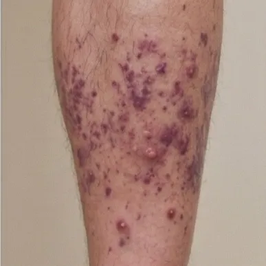 Microscopic Polyangiitis: