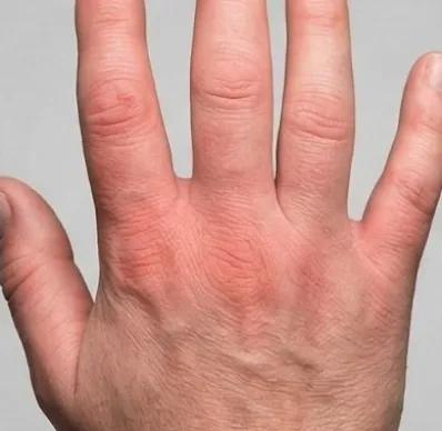 Raynaud’s Phenomenon:
